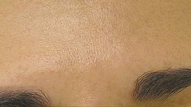 Brown spots after HydraFacial treatment