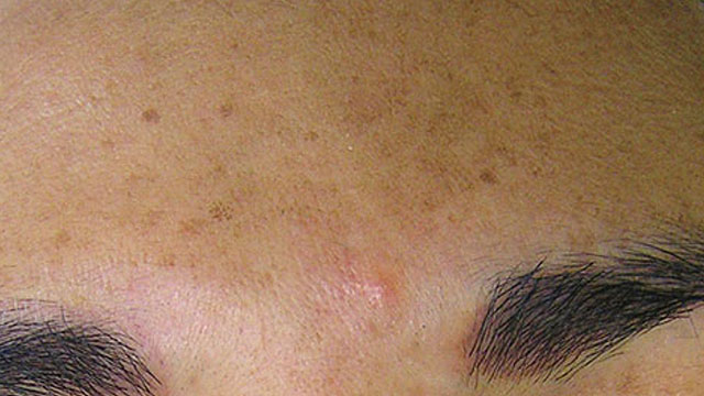 Brown spots before HydraFacial treatment