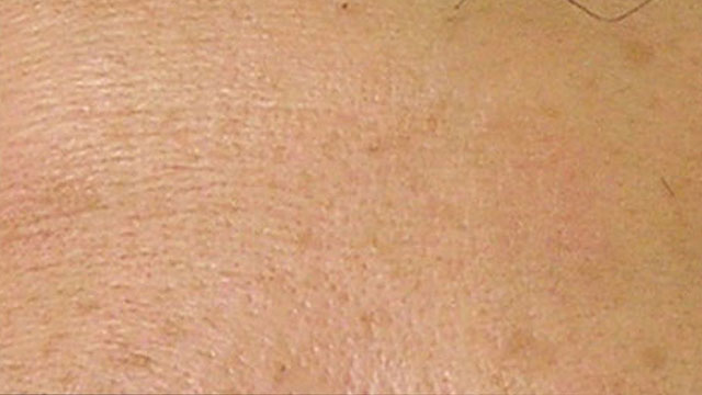 Fine lines after HydraFacial treatment
