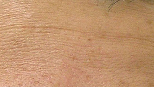Fine lines before HydraFacial treatment